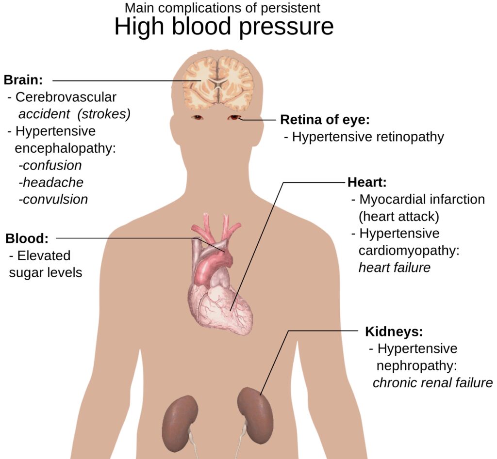 high blood pressure diagram