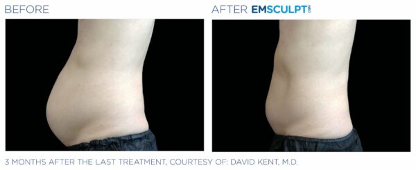 Emsculpt before and after 2