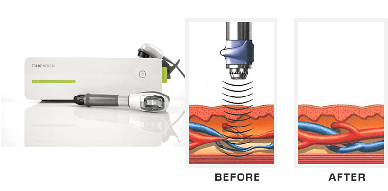 Before and After Sonic Wave Therapy